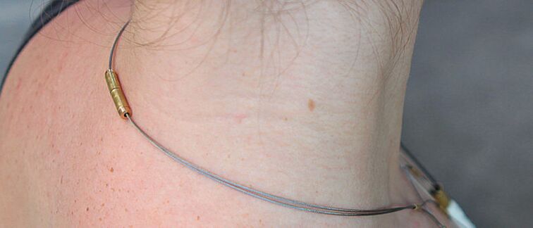 Papilloma on the neck