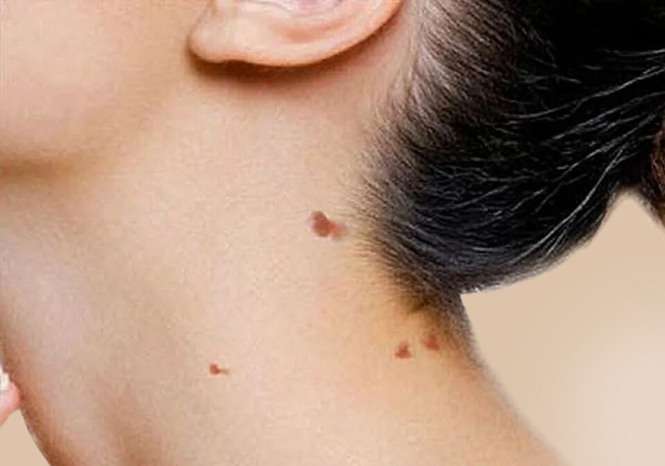 The appearance of papillomas on the neck after activation of HPV in the body