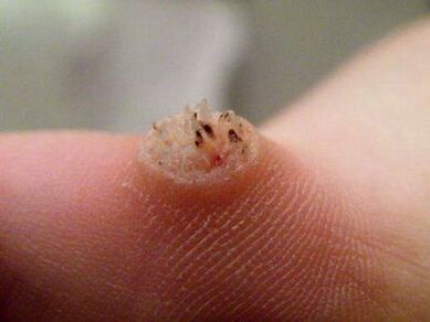 wart on skin how to treat
