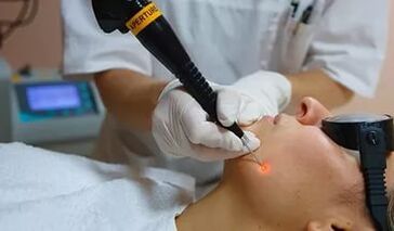 An effective procedure for removing papilloma on the face with a laser