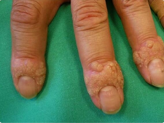 how to remove warts on fingers
