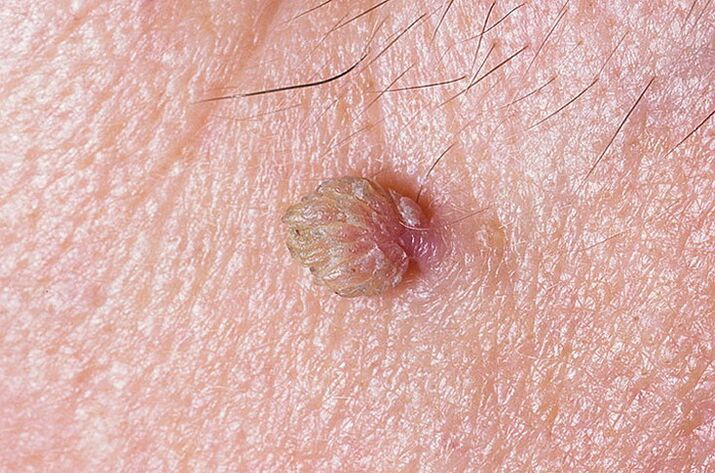 A wart on the skin that can be removed in many ways
