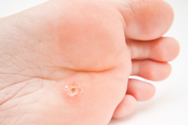 Sole warts