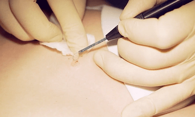 Surgical removal of the plantar wart