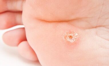 Why are plantar warts appear