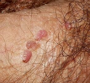 Papillomas on the penis