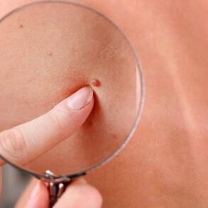 is it possible to remove papillomas