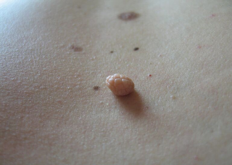 papillomas on the human body