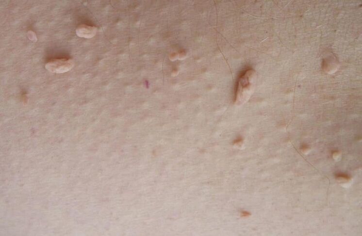 filamentous papillomas on the skin