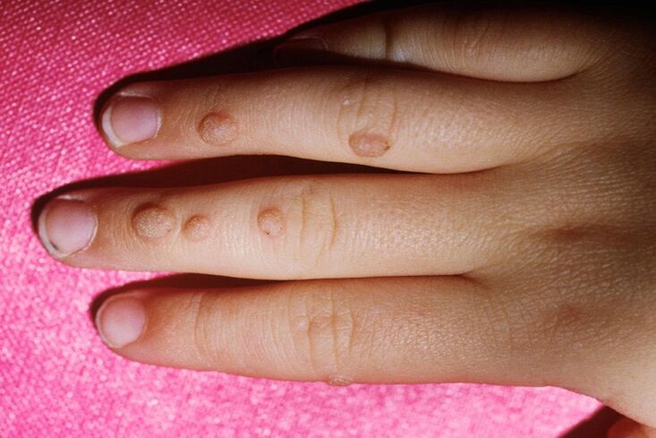 vulgar warts on the fingers