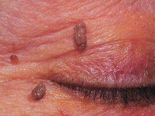 Papillomas on the eyelid